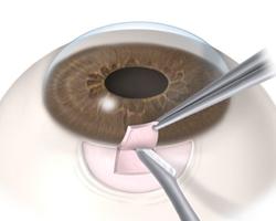 filtrante_de_glaucoma.jpg Cirugía Filtrante de Glaucoma