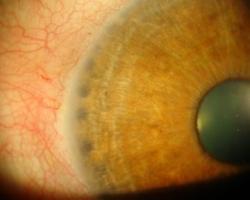 iridoplastia.jpg Glaucoma - Iridoplastia