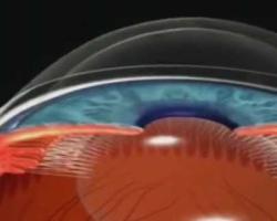 iridotomia.jpg Glaucoma - Iridotomía