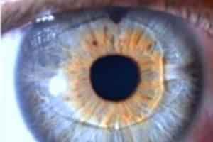 lentes-intraoculares.jpg Lentes Intraoculares Fáquicos
