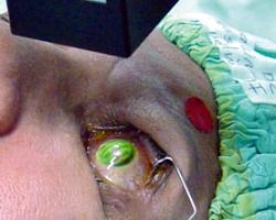 queratocono-crosslinking.jpg Queratocono