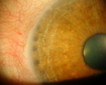Glaucoma - Iridoplastia