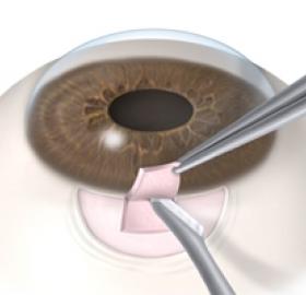 Cirugía Filtrante de Glaucoma