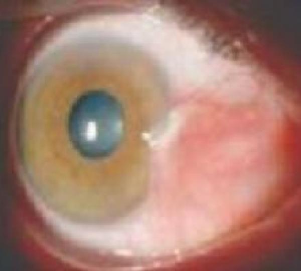 cirugia-pterigion.jpg Cirugía de Pterigión