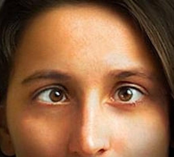 estrabismo.jpg Cirugía Estrabismo