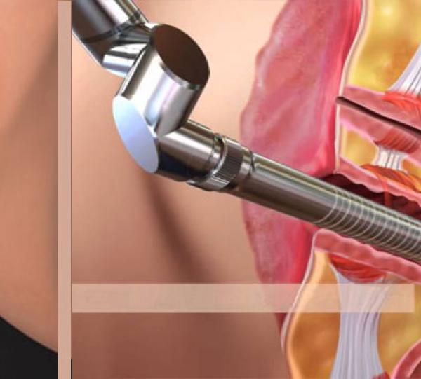 Tratamiento de Incontinencia